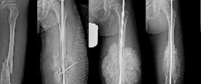 Prótesis mejorará la calidad de vida de pacientes con Osteogénesis Imperfecta