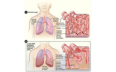 Avanzan estudios sobre fibrosis pulmonar idiopática